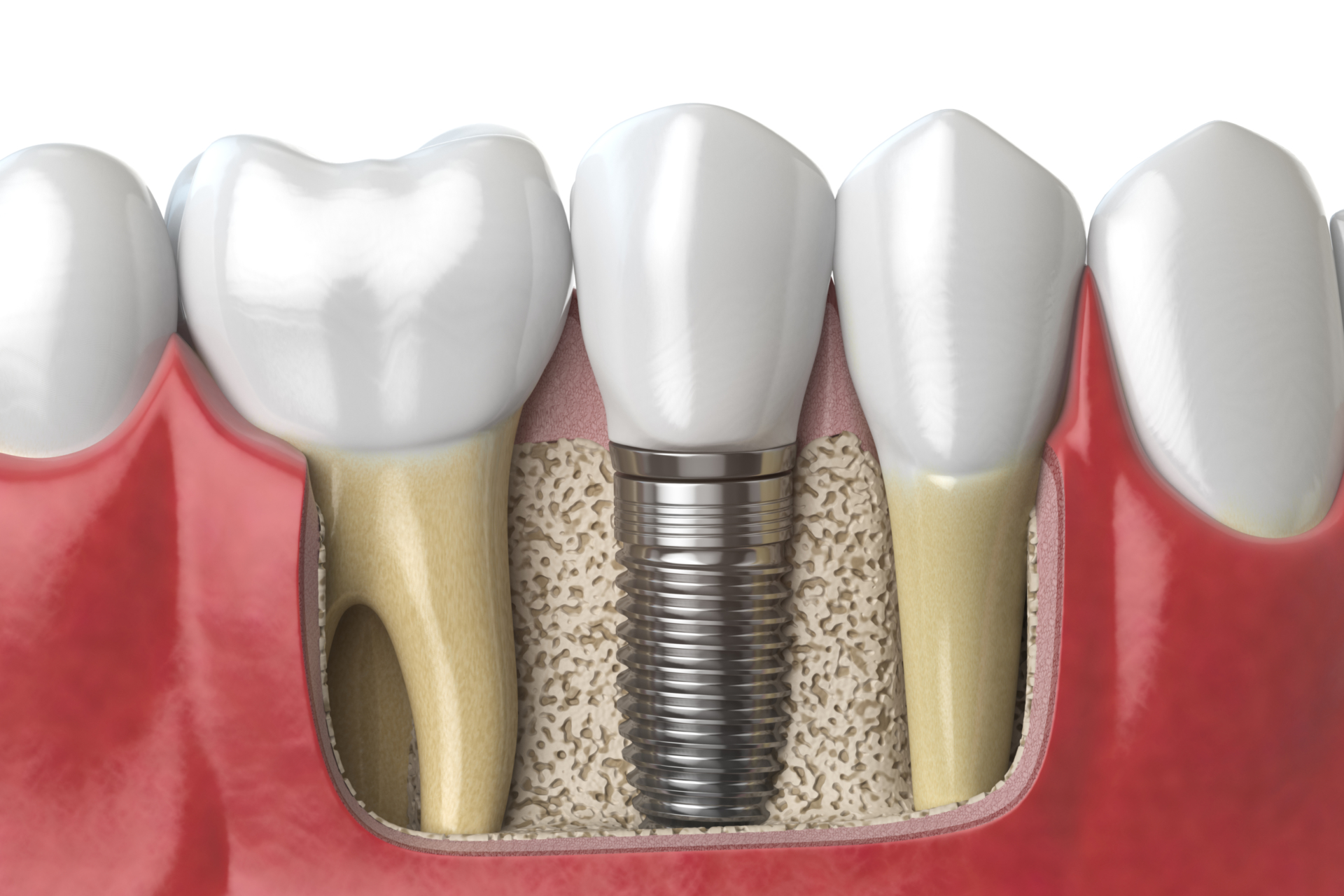 Anatomy of healthy teeth and tooth dental implant in human dentu Anatomy of healthy teeth and tooth dental implant in human dentura. 3d illustration